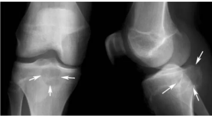Fig. 2 (same patient as Fig. 1) Moderate FDG-uptake (SUV max