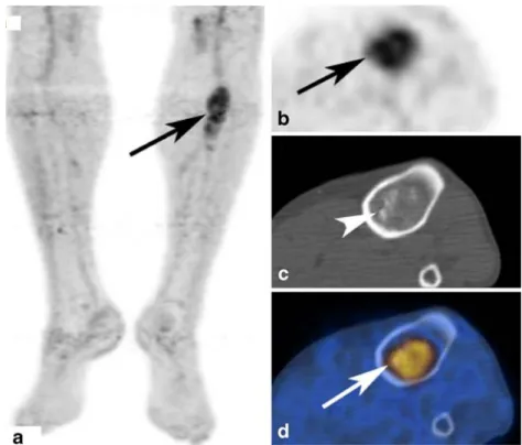 Fig. 5 Conventional X-ray images (Fig. 5) of a 33-year-old female patient with an inhomogeneous ground-glass like lesion (arrows) in the left tibia