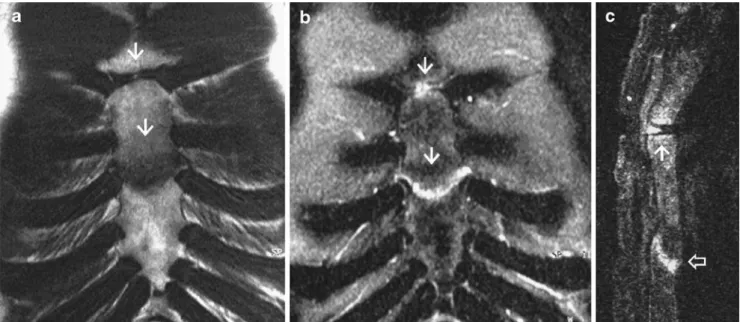 Fig. 4 Thirty-year-old woman with pain localized to the  man-ubrio-sternal synchondrosis after severe sternal contusion