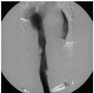 Fig. 4 Femoral venogram depicts successful suprarenal IVC filter insertion just above the thrombus formation