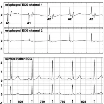 Fig. 1 The two eECG channels (top) show two clearly distinguish- distinguish-able atrial waveforms (A1 and A2), whereas their different  morphol-ogy can be easily overlooked in the simultaneous surface ECG (bottom)