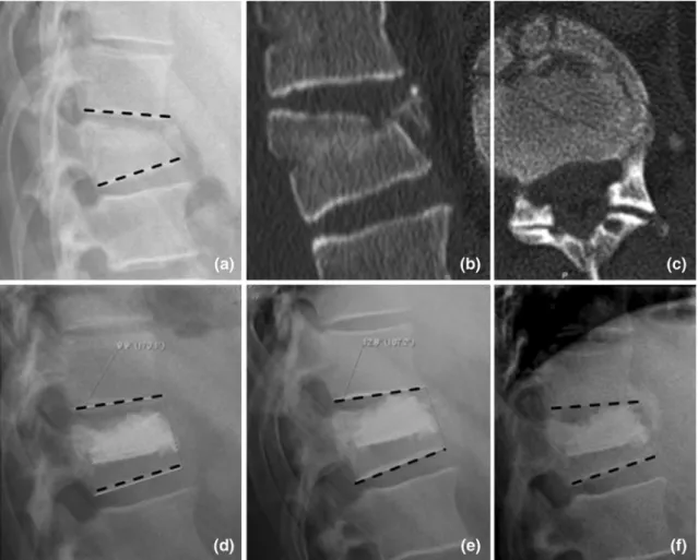 Fig. 1 Incomplete superior burst fracture of T12 (45-year-old male patient) treated with vertebral body stent and  polymethylmeth-acrylate bone cement (PMMA)