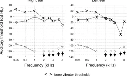 Fig. 1 Air-conduction and bone vibrator thresholds for the right and left ear on separate panels