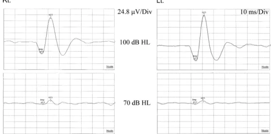 Fig. 2 Air-conducted vestibular-evoked myogenic potentials. Two similar responses have been averaged.