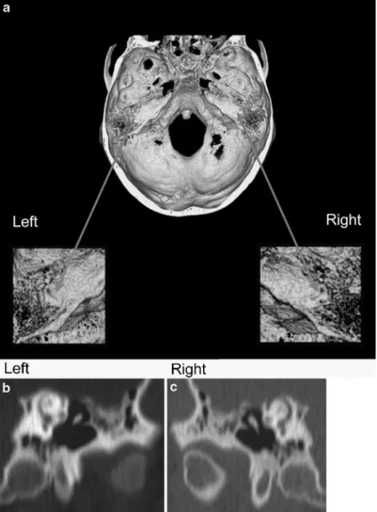 Fig. 5 High resolution computed tomography of the temporal bone in 0.75-mm slides and reconstruction with respect to the anatomy of the superior semicircular canal.