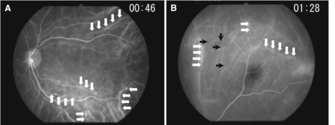 Figure 3. Hypofl uorescent dark dots (HDDs) in late angiographic  phase (patient 4). Numerous HDDs are seen in the late angiographic  phase