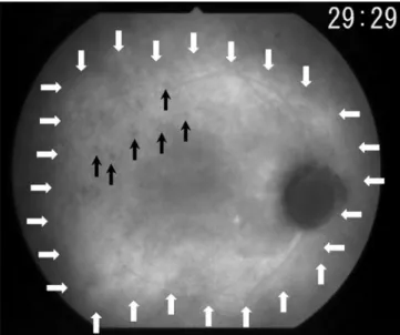 Figure 6. Diffuse late choroidal hyperfl uorescence (patient 10). The  areas of late diffuse hyperfl uorescence are delineated by the white  arrows