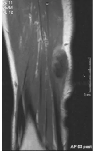 Fig. 2 An MRI scan of the right forearm shows a 5 9 1.5-cm tumor extending into the soft tissues and slight bone marrow edema.