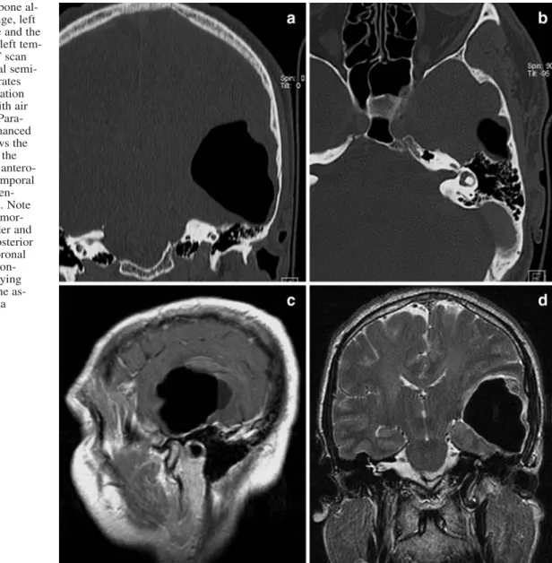 Fig. 1 a Coronal CT (bone al- al-gorithm) reveals the huge, left temporal pneumatocele and the normally pneumatized left  tem-poral bone