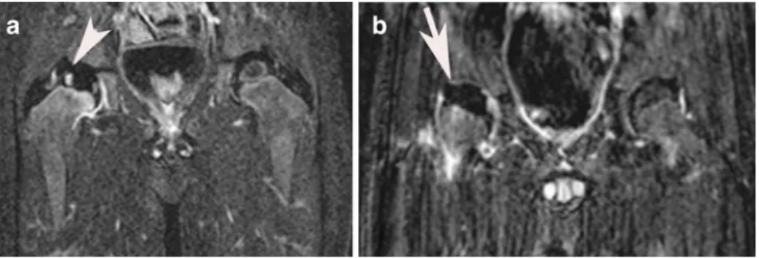 Fig. 1 DGS MR. a A 6.1-year- 6.1-year-old boy. An example of good enhancement of the lateral pillar (arrow)