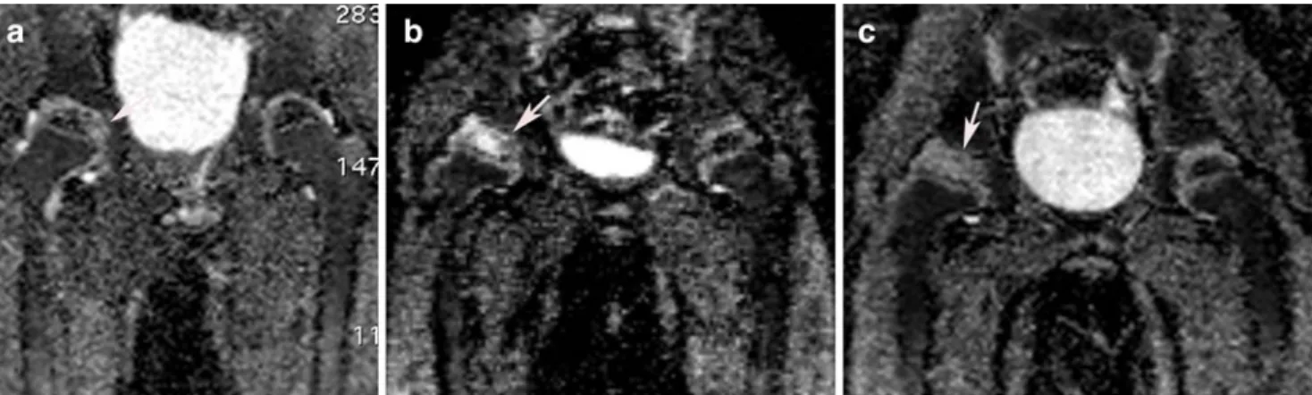 Fig. 2 b400 DWI average map shows different patterns of signal alteration in the pathological femoral epiphysis