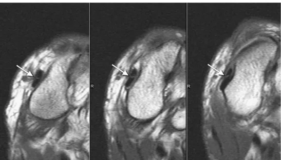 Fig. 9 Four consecutive transverse T1-weighted MR images (left side) and four consecutive coronal T1 weighted MR images (right side) show the course of the peroneus quartus (arrows) muscle in an asymptomatic volunteer