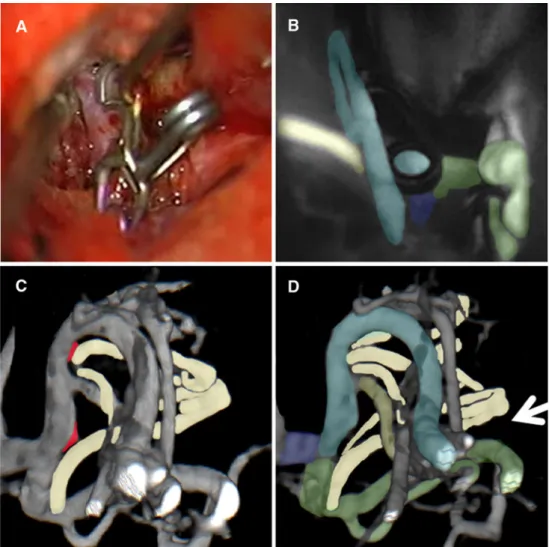 Fig. 3 The aneurysm clipping is checked visually (a). The aneurysm dome is punctured and flow in the different branches is assessed using indocyanine green  angiofluores-cence (b)