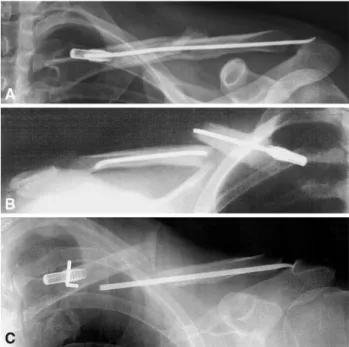 Fig. 5 TEN bending 3 weeks postoperatively after a snowboard injury is shown in a noncompliant patient