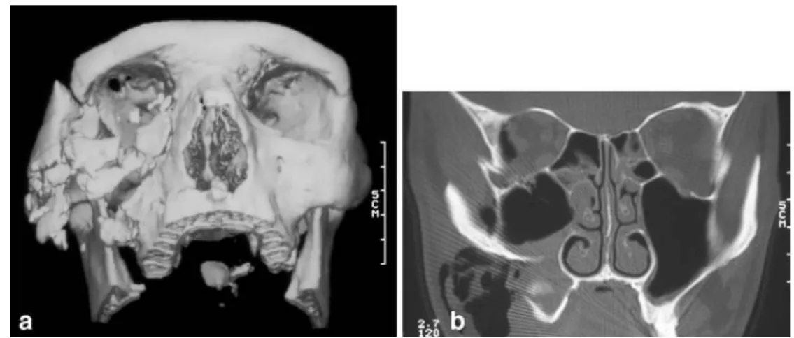 Fig. 4 a Three-dimensional surface shaded display image of a mildly displaced tripod  frac-ture with involvement of the zygomaticomaxillary suture, the infraorbital rim, lateral orbital wall, and zygomatic arch