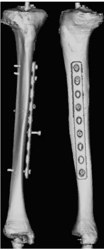 Fig 3. Simulation of osteosynthesis using full-length digital bone models. To date, traditional practical training still relies on plastic bone prototypes.