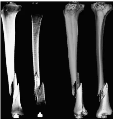 Fig 4. Example of 2D to 3D registration. The fracture as seen on the 2D x-rays has been transposed onto the 3D bone model using a semiautomatic procedure.