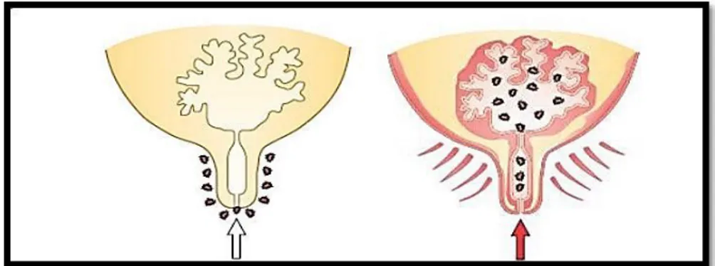 Figure 2: Les bactéries entrent par le canal du trayon et pendant l’inflammation du pis, le lait  est fortement infecté par les bactéries [1]