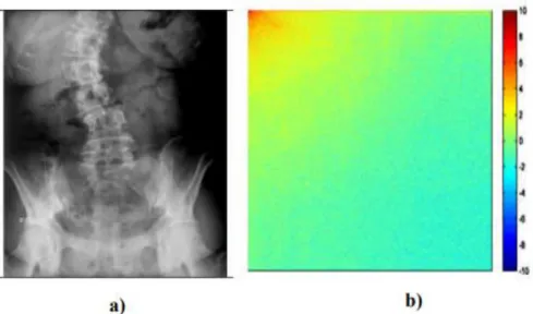 Figure 2.4 : a) Image rachis_ scoliose b) DCT de l’image 