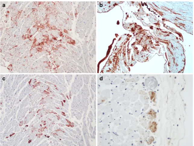 Fig. 1 a, b Exemplarily expression of the marker fibronectin in a case of fatal alcohol intoxication (a, RV grade 2, X100) and pulmonary thromboembolism (b, RV grade 3,100X)