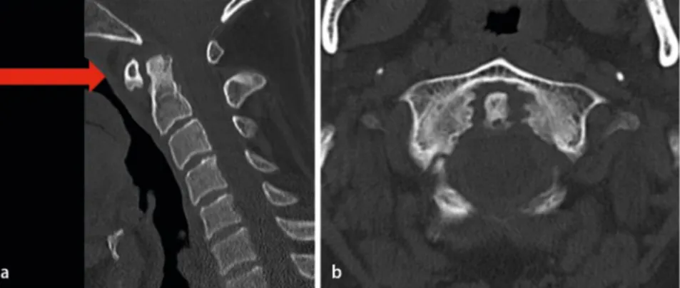 Abb. 1  8  Spiralcomputertomographie der Halswirbelsäule eines 28-jährigen Patienten bei Zustand  nach einem Verkehrsunfall in sagittaler (a) und transversaler (b) Reformation im Knochenfenster ohne   Nachweis knöcherner Verletzungsfolgen. Als Nebenbefund 