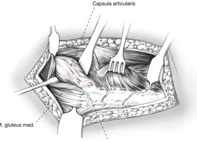 Abb. 3 Nach scharfer Durchtrennung von Subkutis so- so-wie Spaltung der Fascia lata und der Bursa trochanterica sind die Insertionen der Musculi gluteus medius et  va-stus lateralis dargestellt