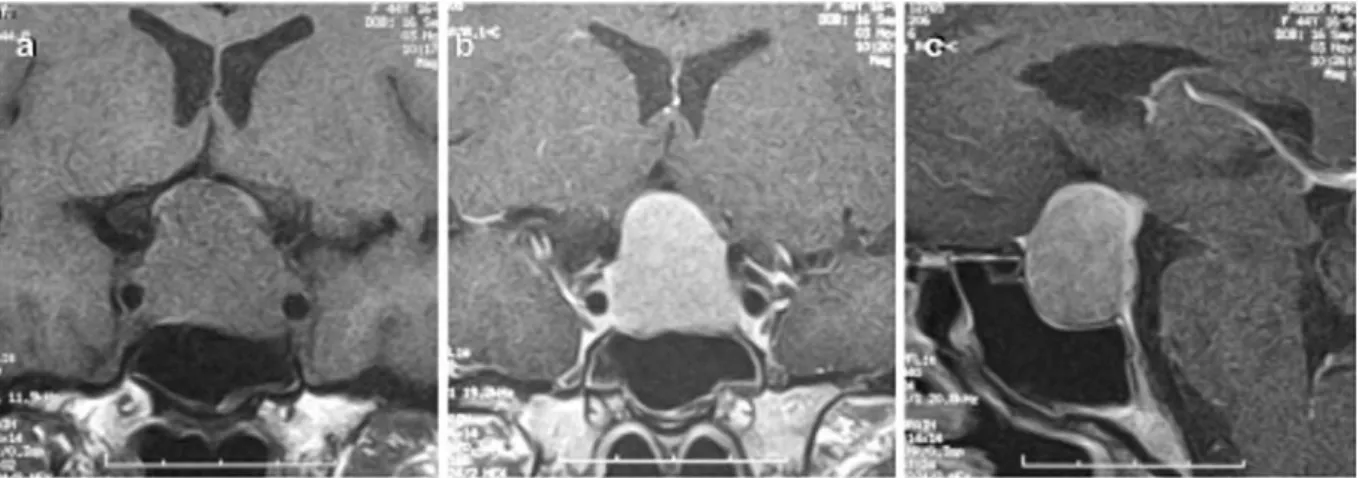 Fig. 1 Imaging characteristics of LANT. T 1 weighted frontal MRI scan (a) to show isointense pituitary tumor with suprasellar extension and partial encirclement of carotid arteries