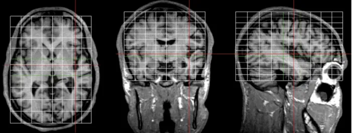 Fig. 2 Analysis of brain lesions in Talairach coordinates. MRI scans were acquired with a 1.5-T Siemens Vision and were displayed and analysed using OrthoViewer