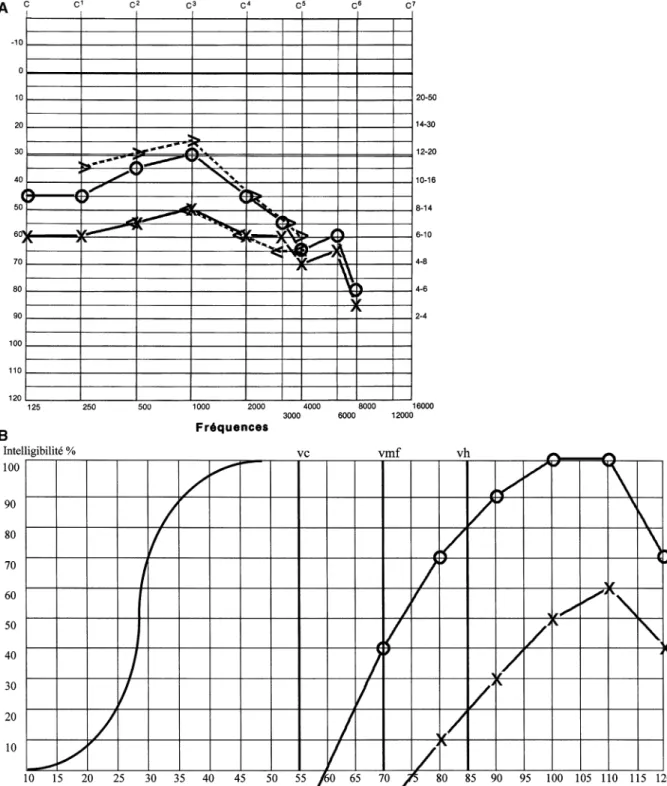 Fig. 1 Audiological evaluation in April 2003. a Pure tone audiogram: pure tone average (PTA) between 0.5–4 KHz of 37 dB HL on the right (circle) side and of 55 dB HL on the left