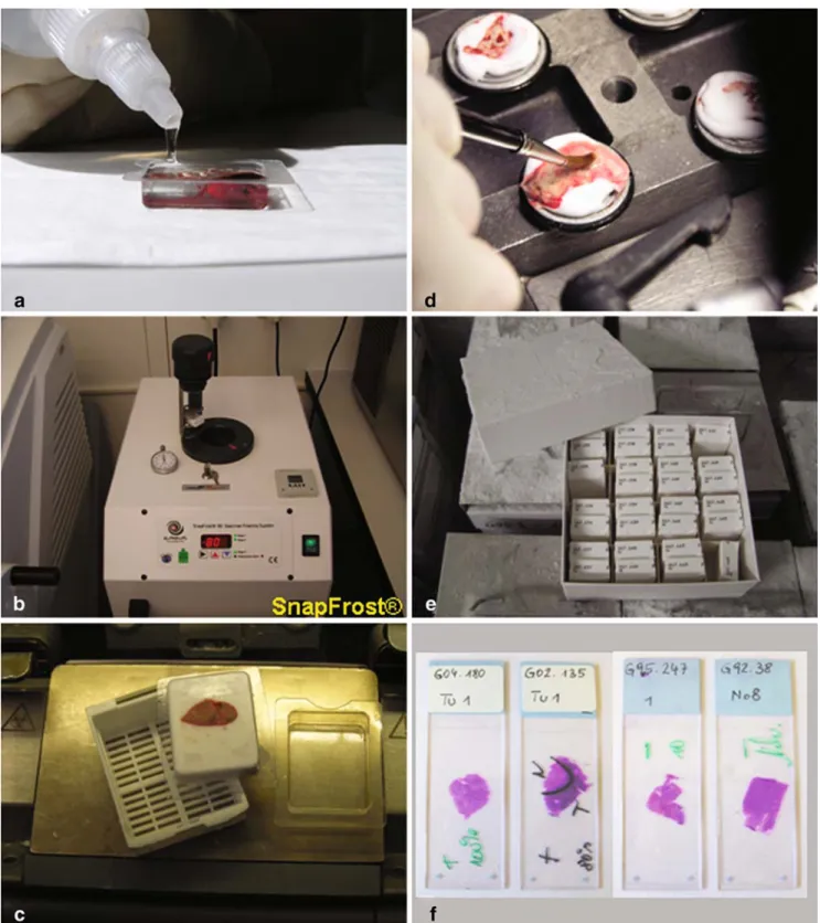 Fig. 1 Tissue processing for rapid section (a – c) and tumor tissue banking (a – f). Tumor tissue in plastic mold embedded with OCT (a).