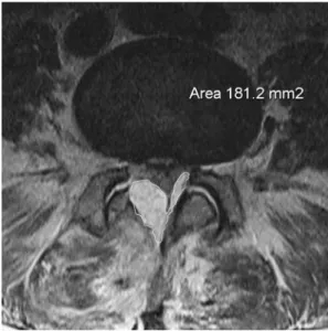 Fig. 4 Postoperative MRI in a patient with compressive symptoms.