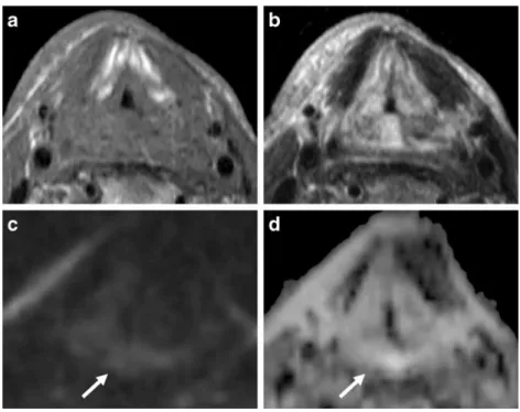 Fig. 3 MR images of a 65-year- 65-year-old man with hoarseness after radiotherapy for a laryngeal  tu-mour
