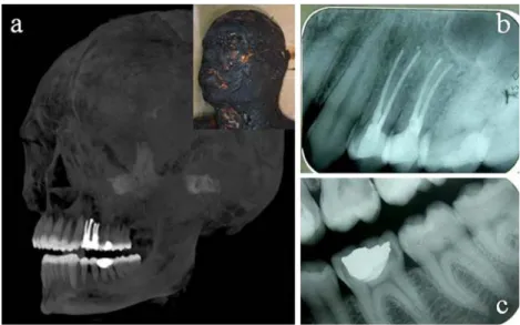 Fig. 1 a MIP of postmortem CCT data of a burned corpse with window settings at 2,700 HU (w) and 1,800 (c) and an oblique image orientation adapted to the projection of the antemortem radiographs well displaying the dental work that was performed