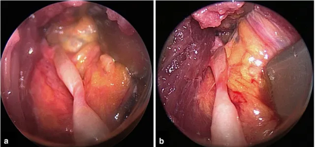 Fig. 2 Combined compression/hour-glass constriction neuropathy of the radial nerve; a the lesion was observed beneath an aberrant compressive band 7–8 cm proximal to the lateral epicondyle (Patient 1 of the series)