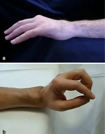 Fig. 4 Drawing of the skin incision in endoscopically assisted proximal median nerve decompression