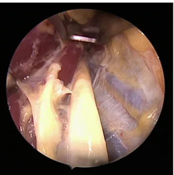 Fig. 6 Median nerve proximally to the incision after endoscopic decompression in proximal median nerve neuropathy (Patient 5 of the series)