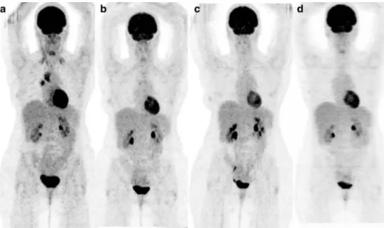 Fig. 4 A 46-year-old female patient (no. 2) with a melanoma resected at the flank 1 year before (Breslow 1.7 mm)