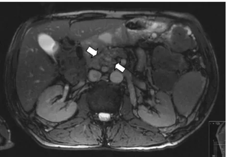 Fig. 2 Axial magnetic reso- reso-nance image (T2) with diffusely enlarged pancreas head (arrows) in acute pancreatitis
