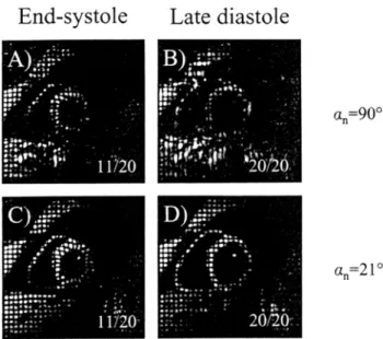 Fig.  7.  Effect of  RF-excitation  optimization  for  slice-following  CSPAMM myocardial tagging