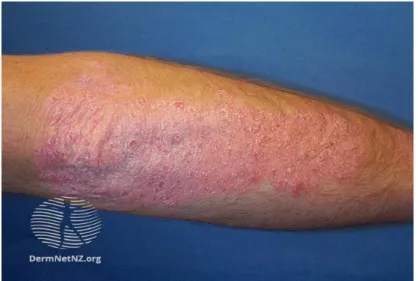 Figure 1: Psoriasis du coude [7] 