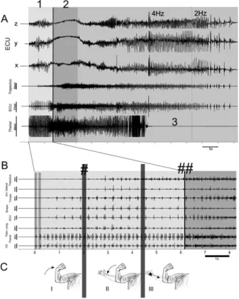Figure 1. Electromyographic and phenomenological phantom correlates of an unexpected cTBS-induced seizure in a 24-year-old experimental participant