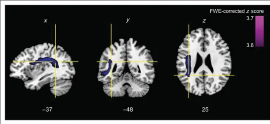 Figure 5. VLSM: results of the VLSM. Voxels with damage that was a significant predictor for increased gaze shift latencies because of higher lexico-syntactic complexity in purple