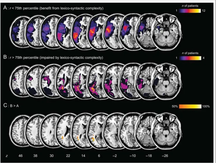 Figure 6. Lesion subtraction analysis. (A and B) Overlap maps of the brain lesions in the two patient subgroups (A, patients benefiting from lexico-syntactic complexity; B, patients impaired by lexico-syntactic complexity)