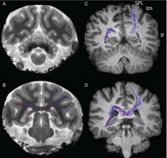 Figure 10. Individual variability in the number of streamlines connecting to contralateral striatum in human cases.