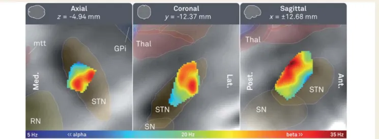 Figure 1 Predominant frequencies of oscillatory activity recorded during rest in 54 patients (309 artefact-free channels) were mapped to the subthalamic area in standard stereotactic space