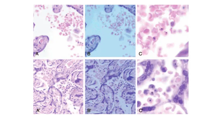 Figure 1. Histological sections of placentas with Plasmodium vivax monoinfections showing parasitized maternal red blood cells