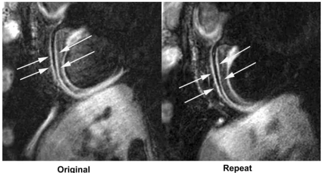 Figure 2 3D black-blood RCA vessel wall images, obtained 1 month apart, demonstrating excellent visual reproducibility.