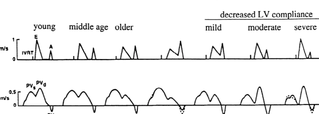 Fig. 2. Schematic representation of transmitral and pulmonary venous flow pattern according to Appelton and Hatle [21]