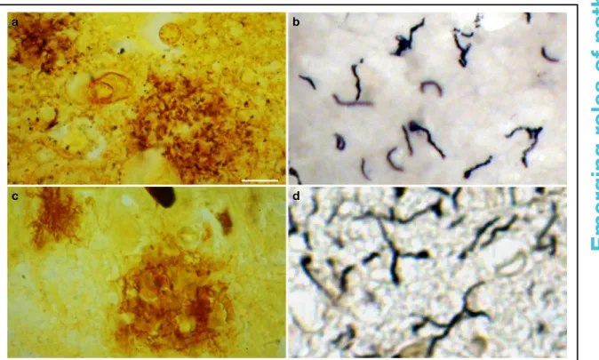 Figure 1. Distribution of spirochetes in the atrophic form of general paresis and in the frontal cortex of an Alzheimer disease (AD) patient with Lyme neuroborreliosis