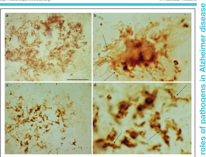 Figure 2. Spirochetes detected in the frontal cortex of neuropathologically confirmed Alzheimer disease cases